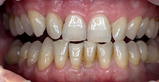 Čiščenje zobnega kamna – pred