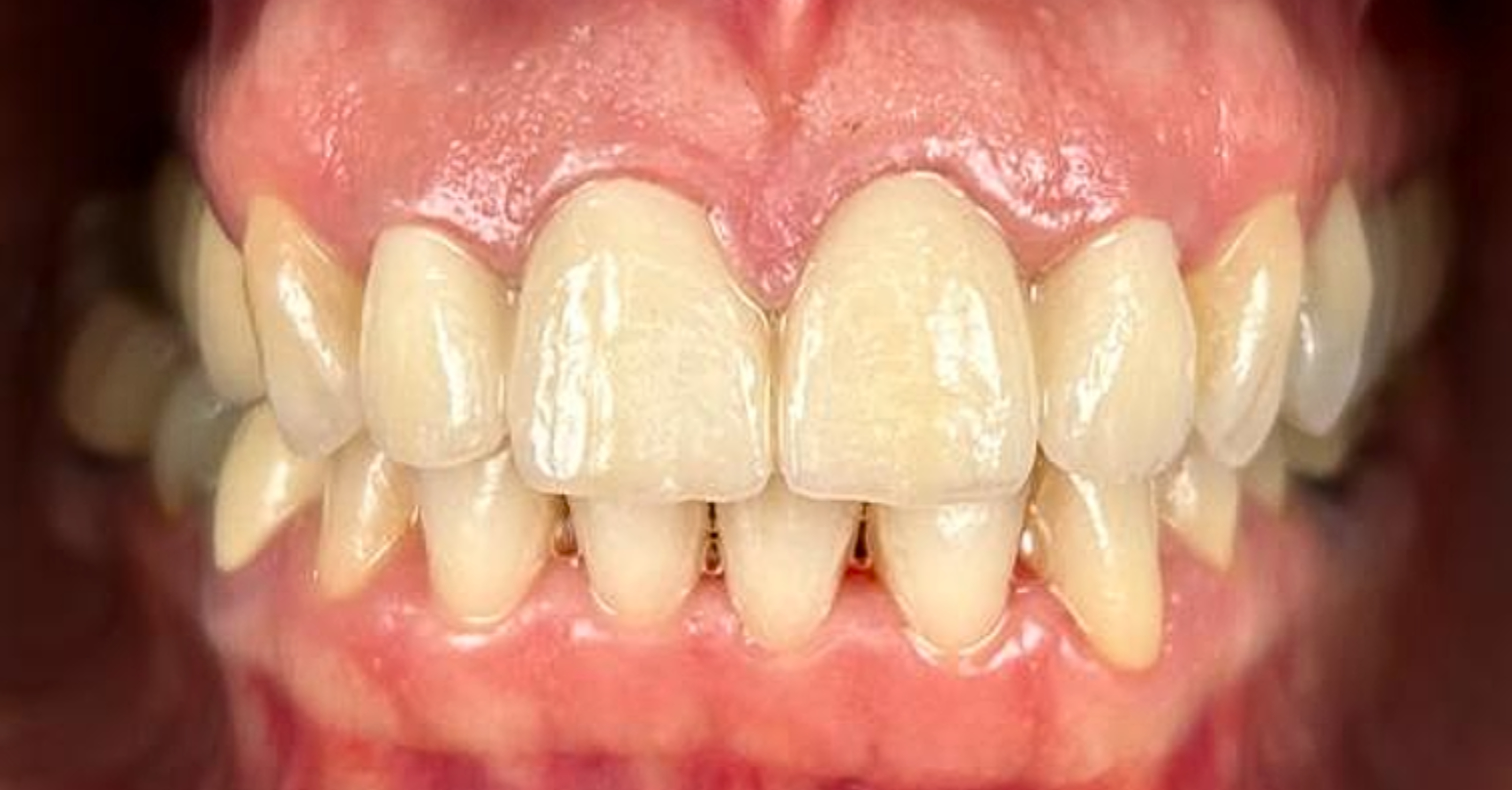 Cirkonske zobne krone potem Hrvaška