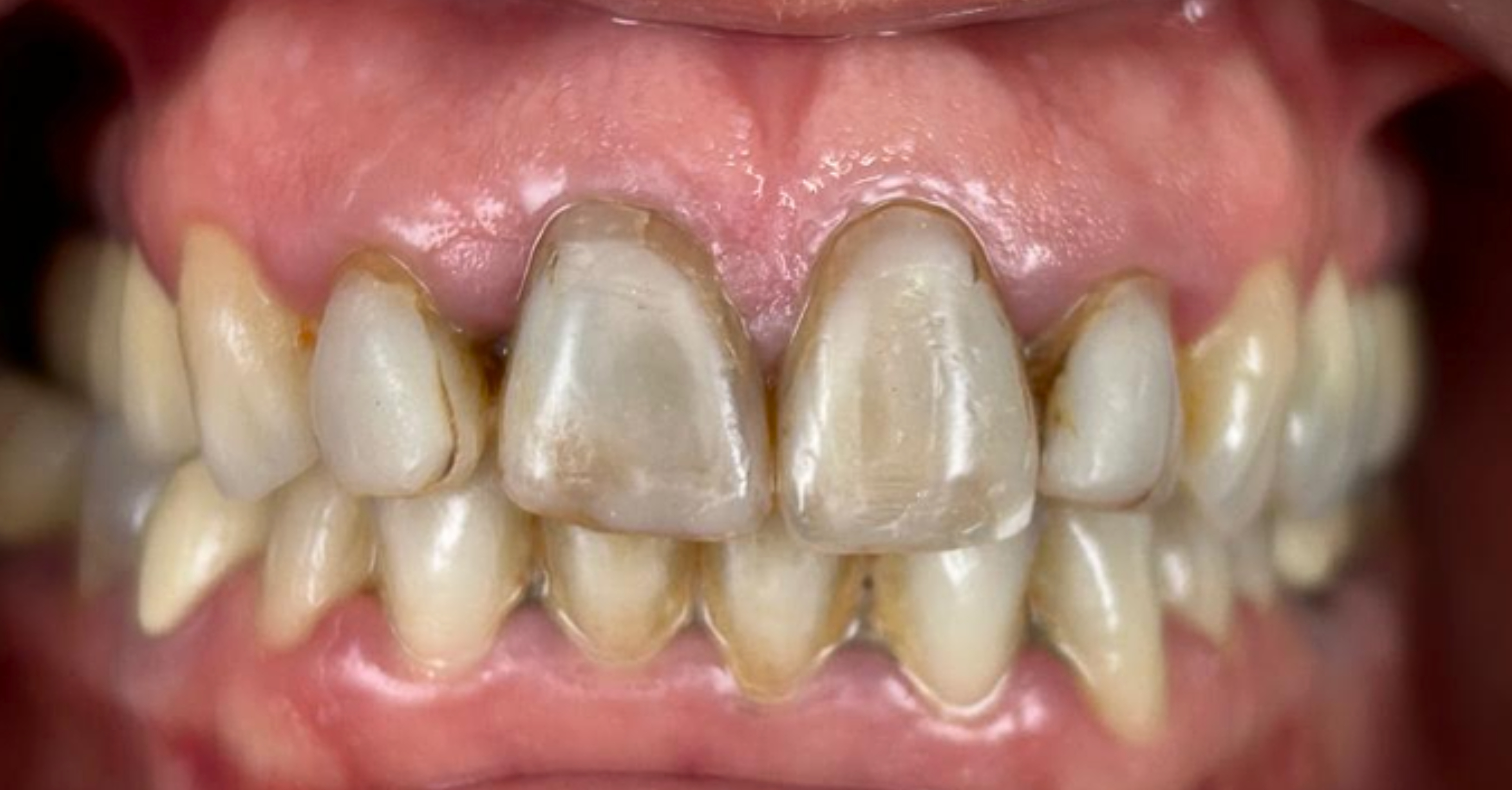 Cirkonske zobne krone prej Hrvaška