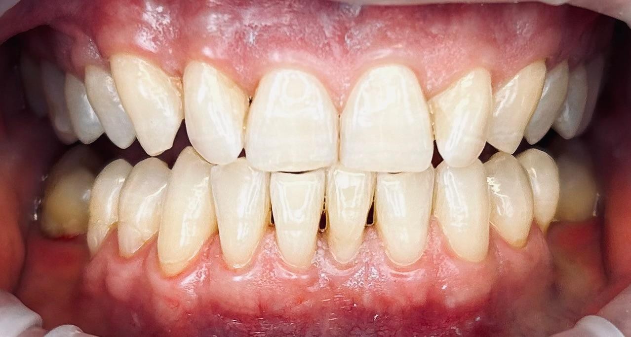 Čiščenje zobnega kamna – po