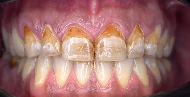 Kompozitne luske – pred