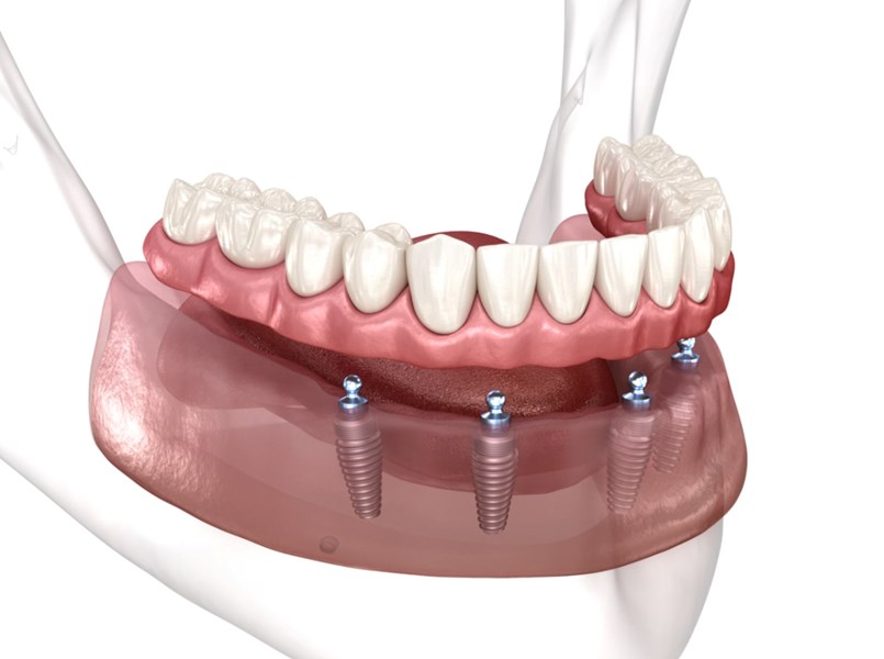 zubna proteza na četiri implantata