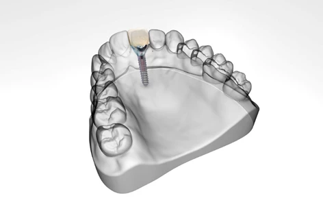 zubni implantati