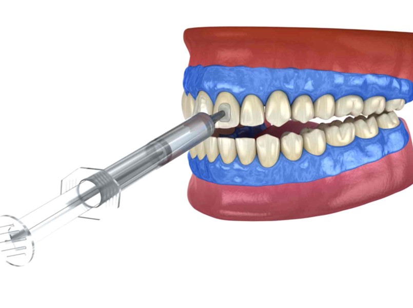 come sbiancare i denti