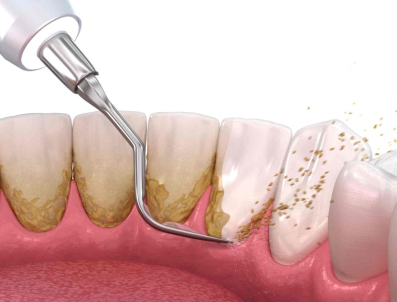 come togliere il tartaro dei denti
