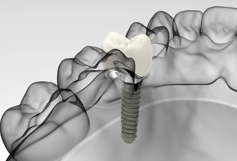 corona dentale croazia