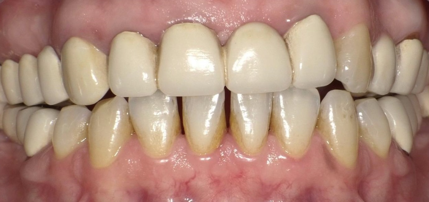 corona zirconio dentale su impianti prima