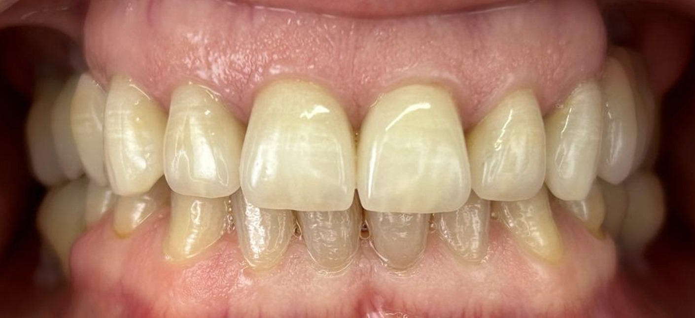 corone senza metallo dopo