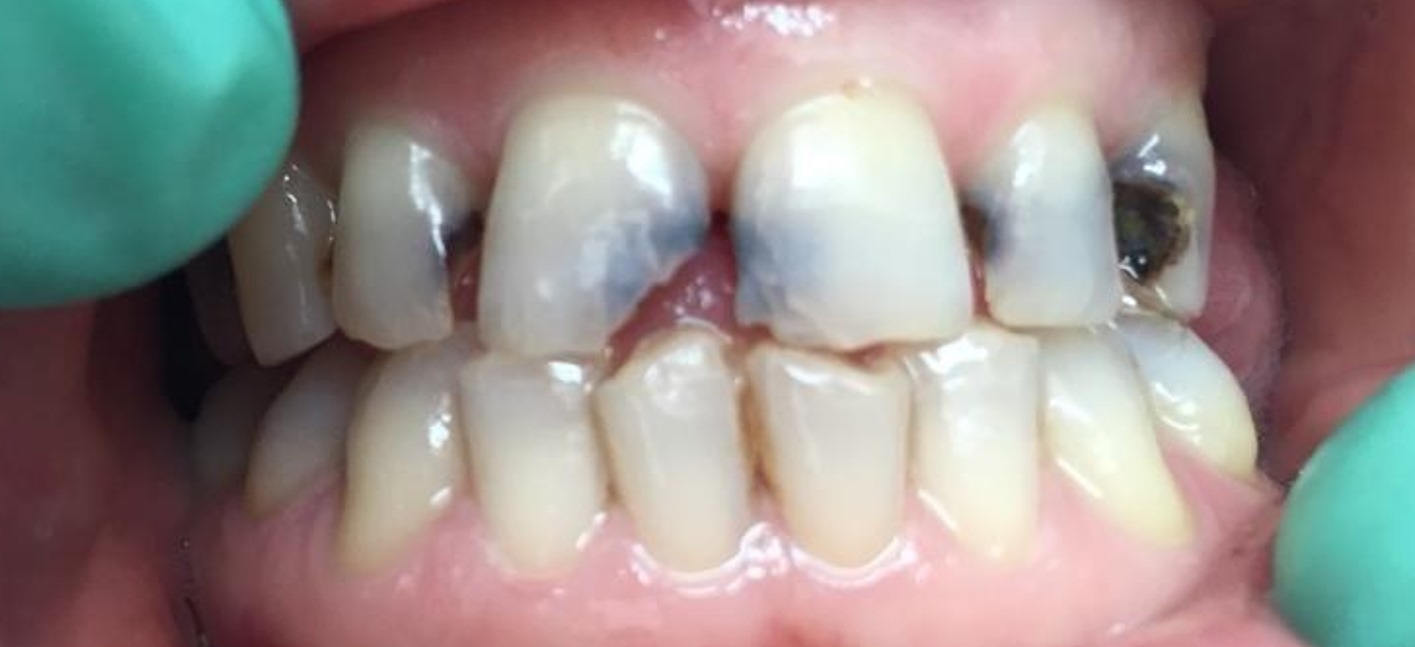 corone senza metallo prima