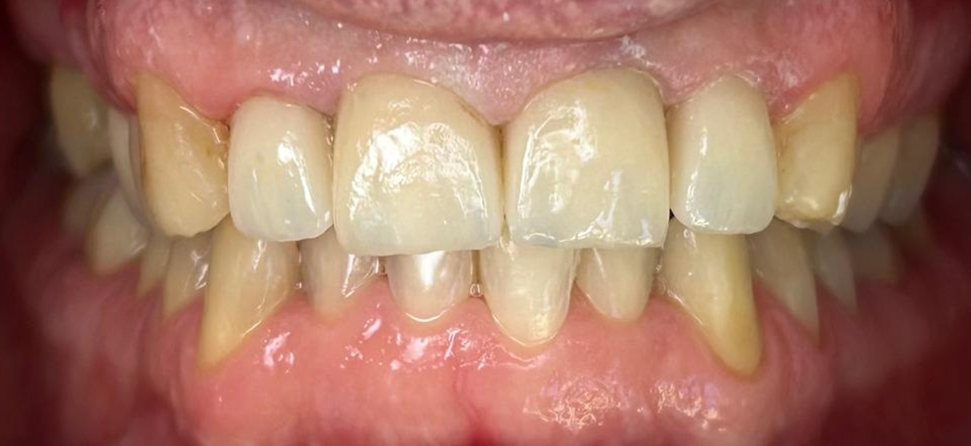 corone zirconio dopo