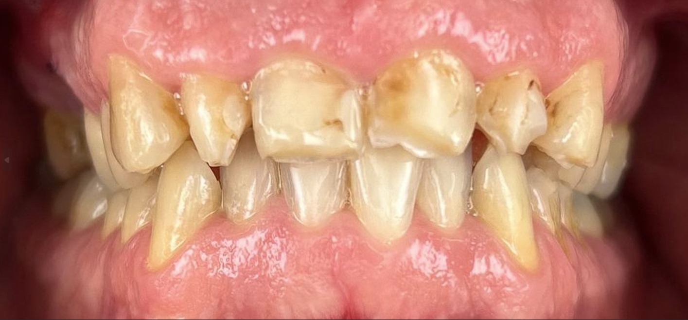 corone zirconio prima