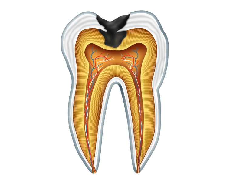costo devitalizzazione dente 
