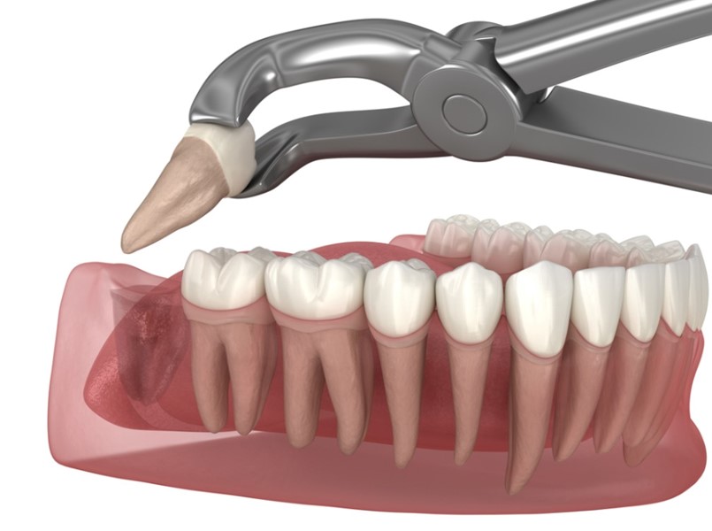 costo estrazione dente del giudizio