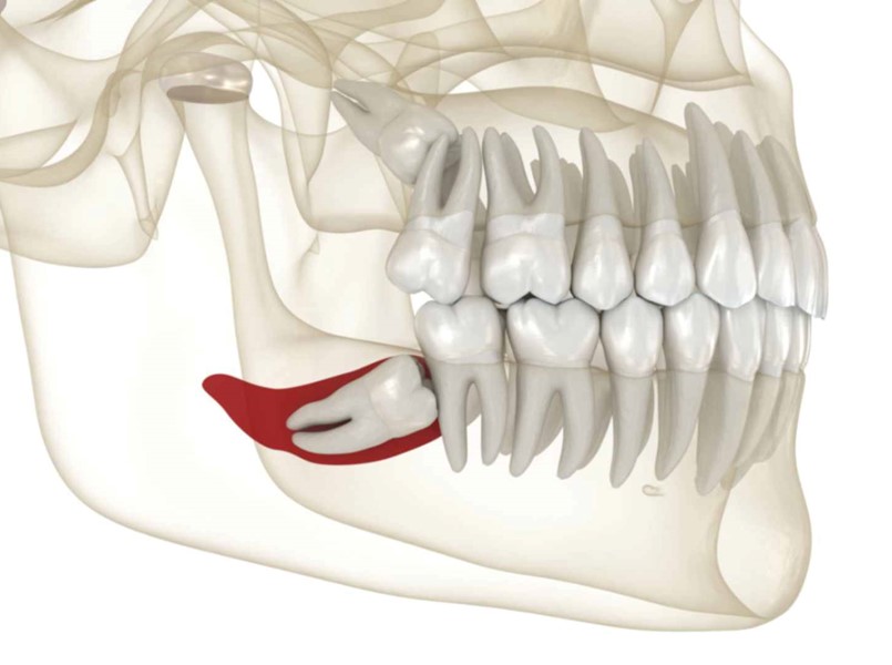 costo estrazione dente