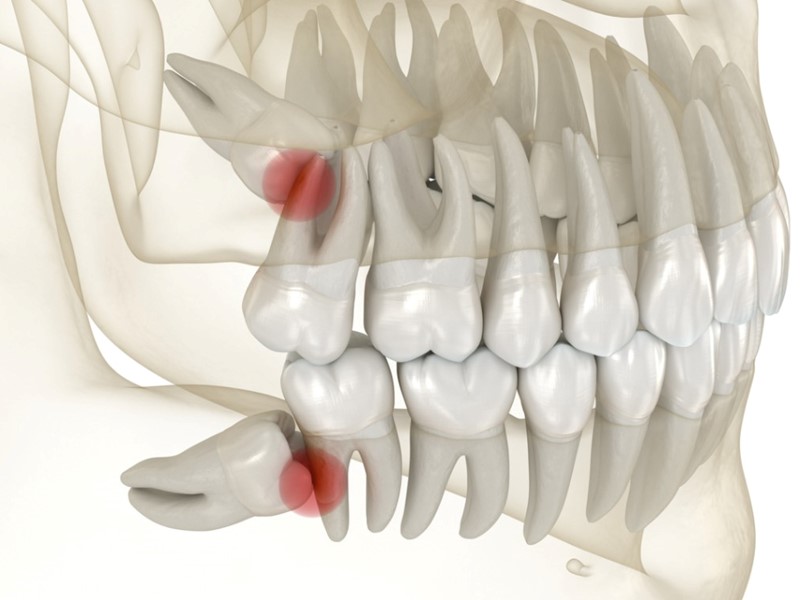 dente del giudizio dolore
