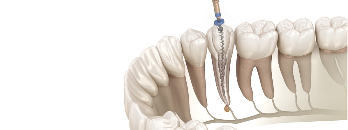 devitalizzazione dente