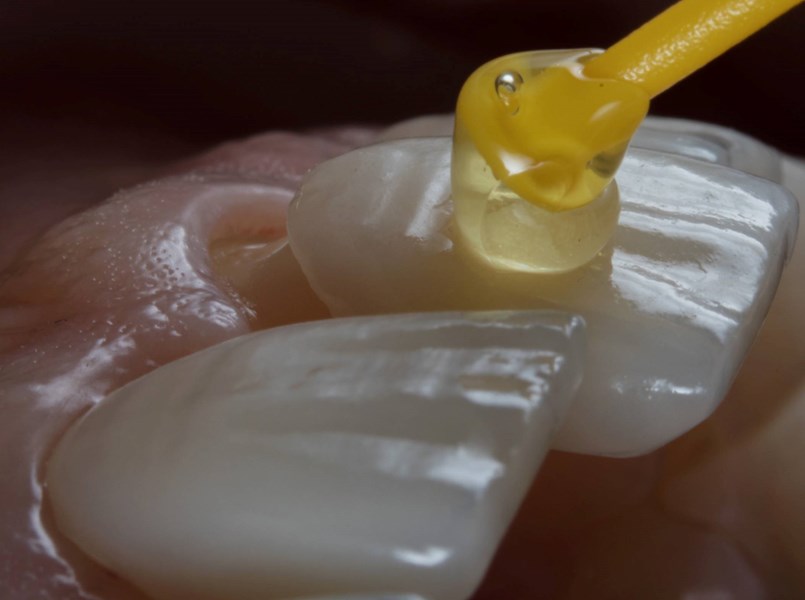 faccette dentali costo