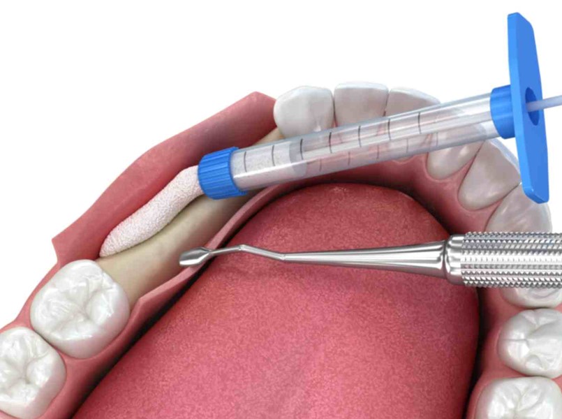 innesto osseo dentale e doloroso