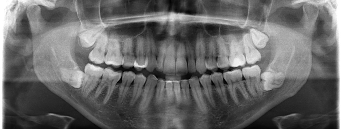 Panoramica dentale