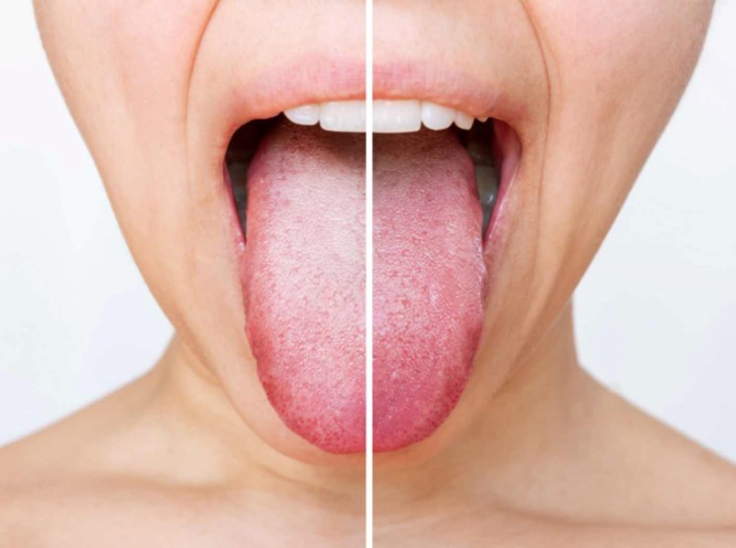 patina bianca sulla lingua