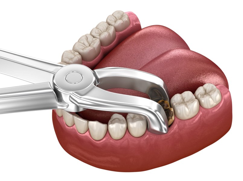 postumi estrazione dente