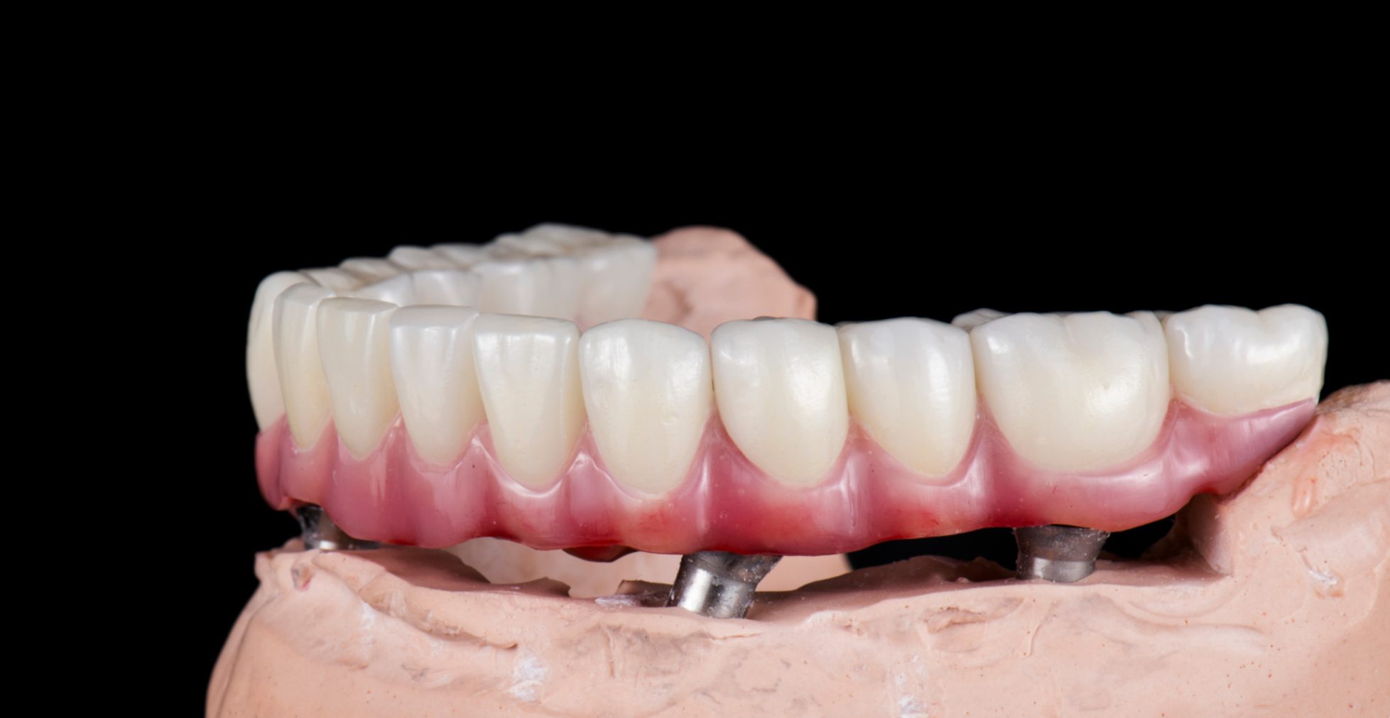 protesi dentale fissa