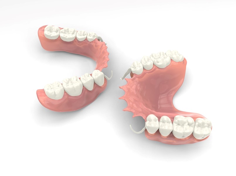 protesi dentarie mobili invisibili