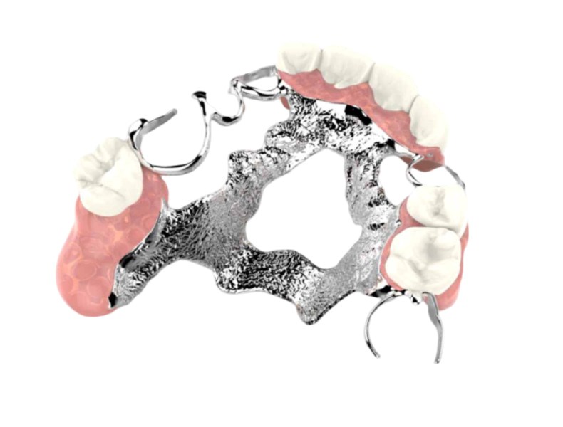 protesi dentarie parziale