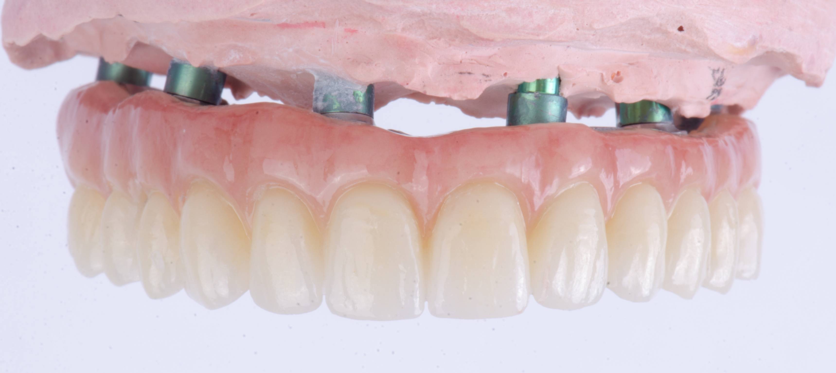 protesi fissa su 4 impianti costi