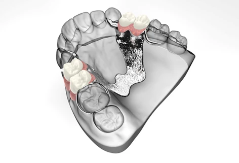 protesi parziale croazia