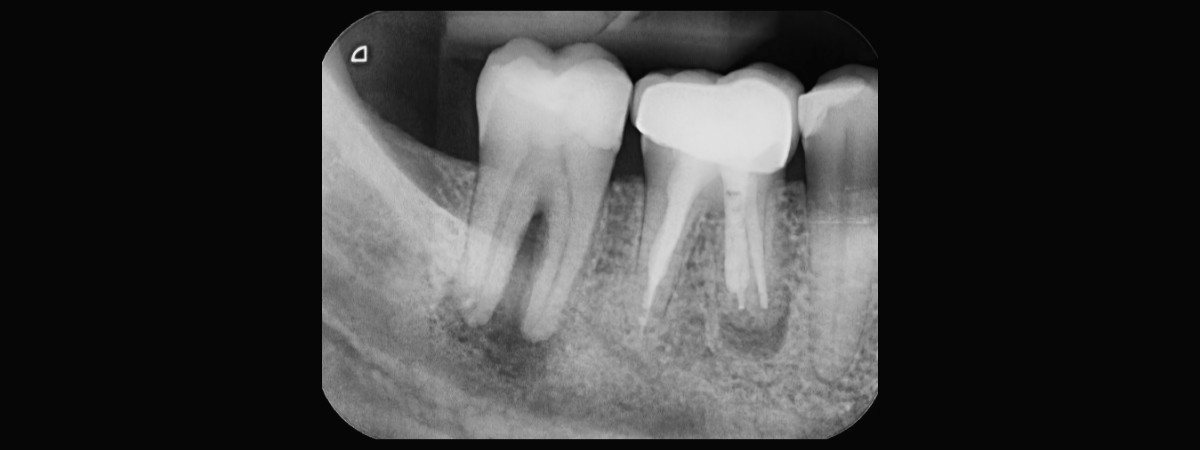 radiografia denti