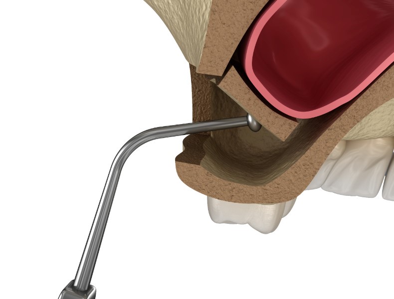 rialzo seno mascellare prima e dopo