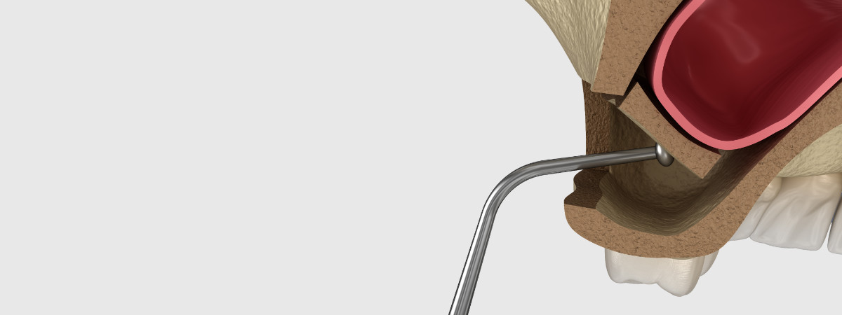 rialzo seno mascellare