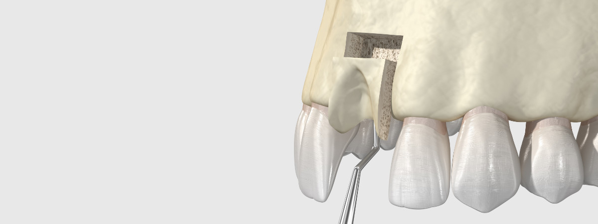 rigenerazione ossea dentale