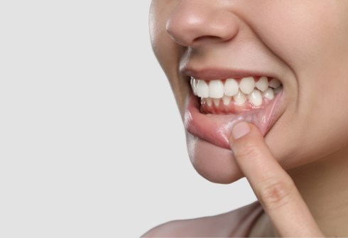 sanguinano le gengive