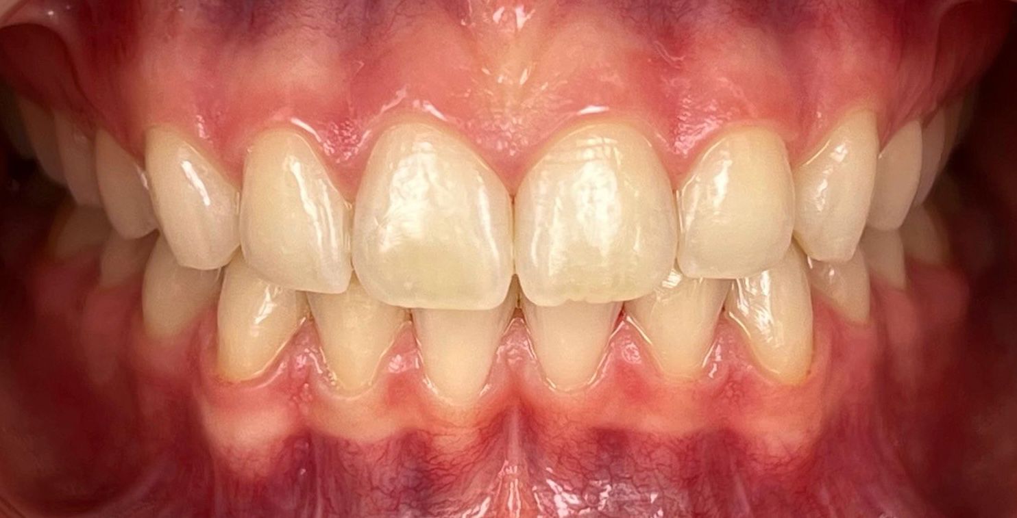 sbiancamento dentale dopo