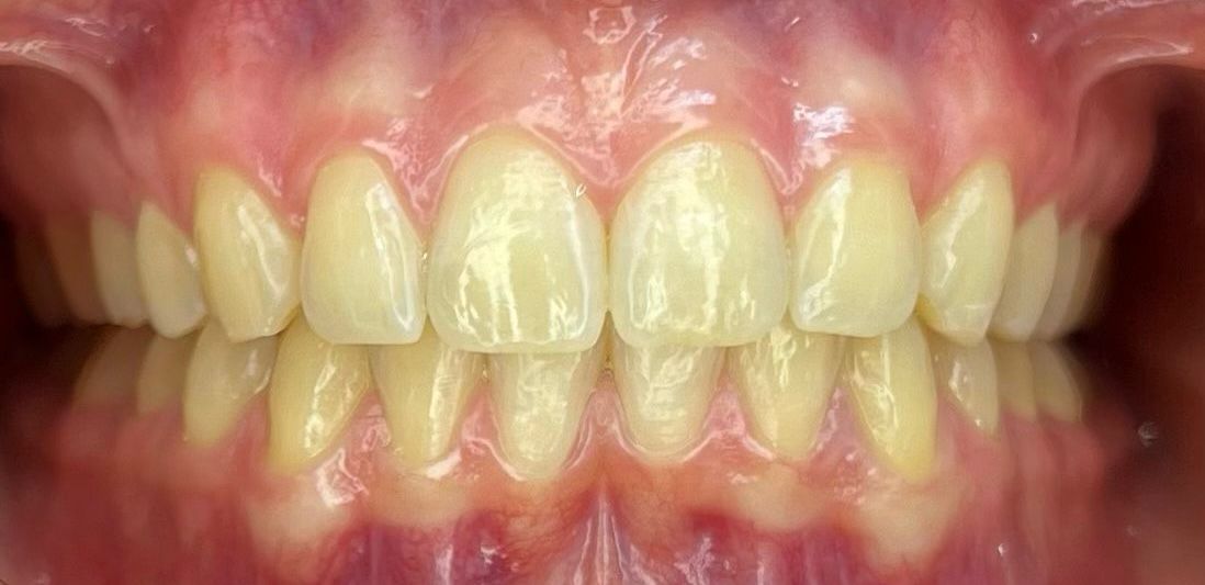 sbiancamento dentale prima