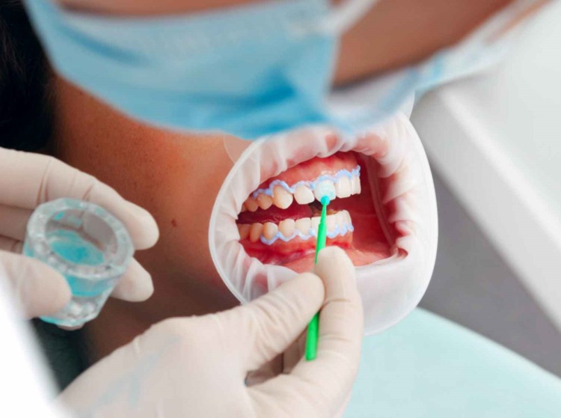 sbiancante denti