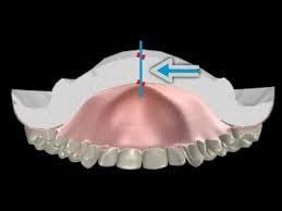 održavanje zubne proteze - CentroDENT Rijeka