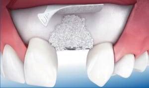 regeneracija zubne kosti