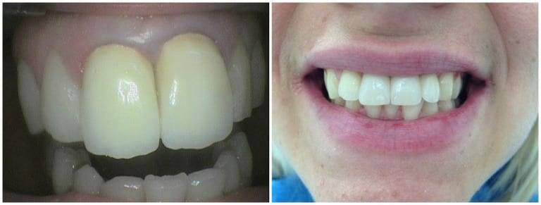 Zubne krunice na implantatima