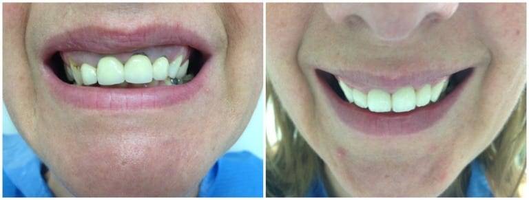 Cirkonske zubne navlake prije/poslije –