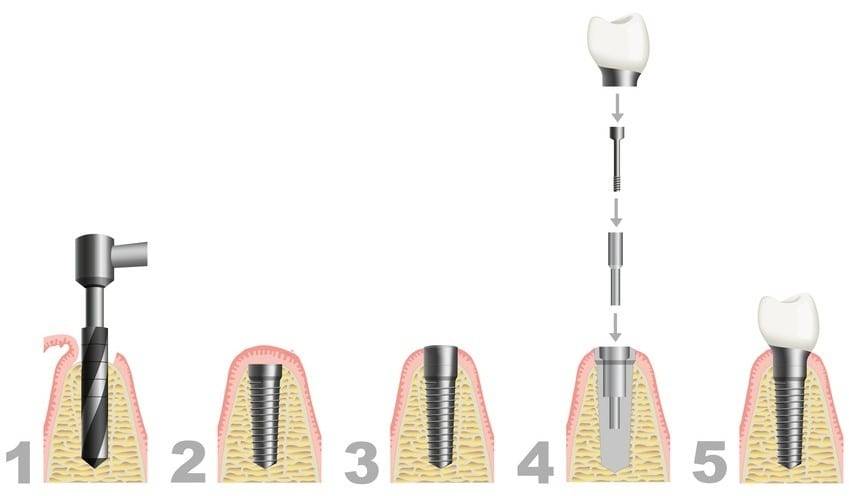 Dentalni implantati faze